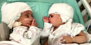 Conjoined Israeli twins